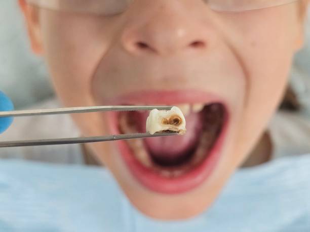Best Emergency Tooth Extraction in Lipscom, AL